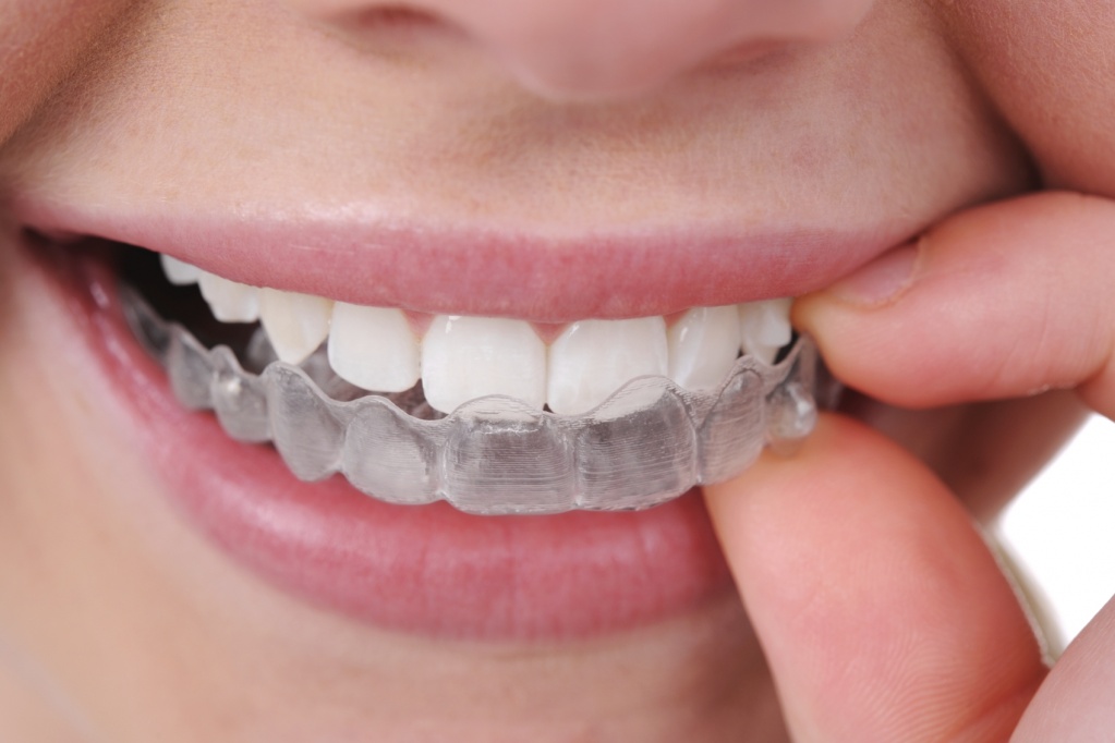 invisalign-Geneva-Dental-Lounge-orthodontics.jpg